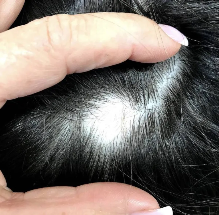 Alopecias Areatas